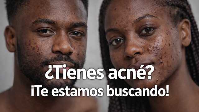 Testadores AFRO con acné para estudios cosmeticos